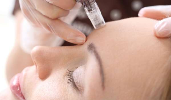 The Aftercare Of Microneedling: How To Take Care Of Your Skin Post-Treatment